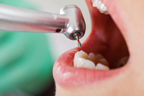 Best Emergency Wisdom Teeth Removal in Dexter, MO
